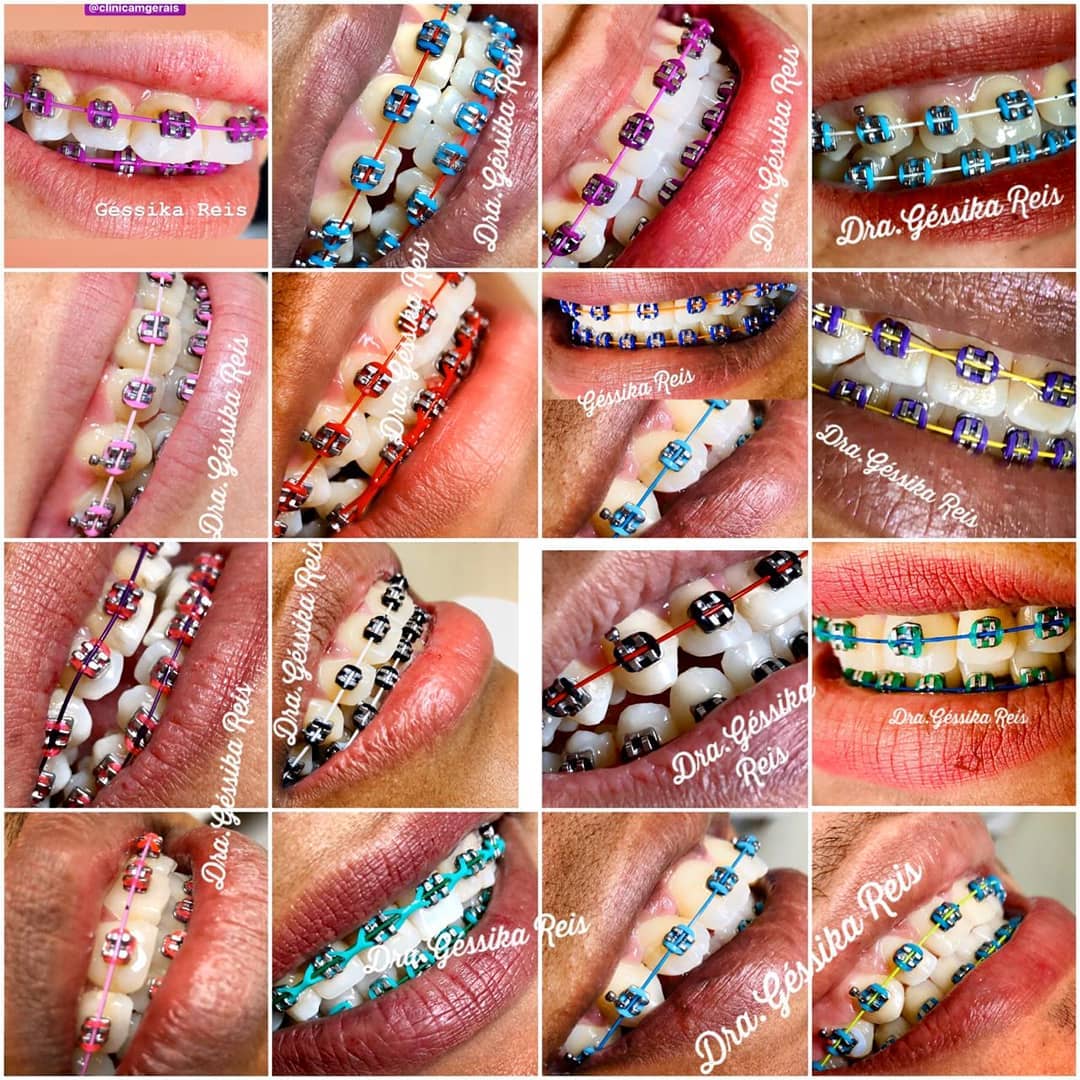 Ortodontia (aparelho fixo)