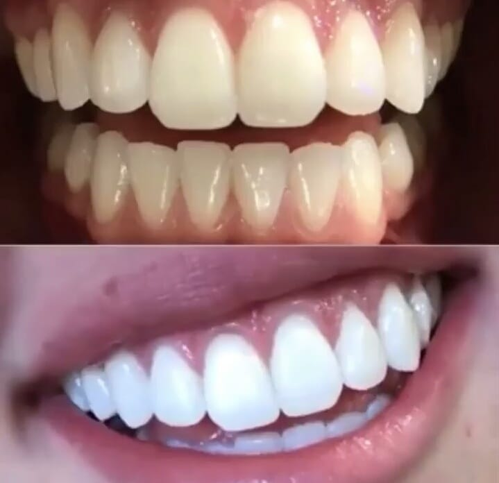 Clareamento Dental