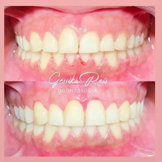 Facetas e harmonização — proporção do sorriso corrigida.